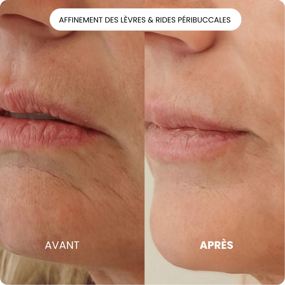 Kit de Micro Infusion