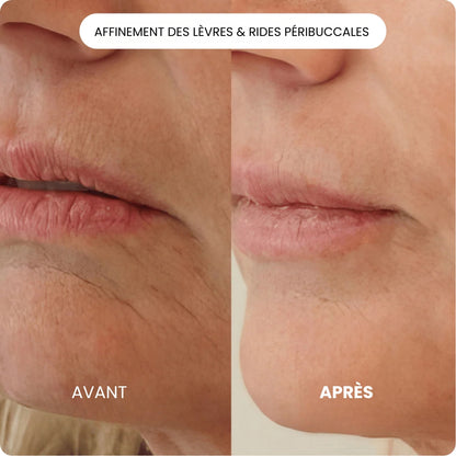 Kit de Micro Infusion