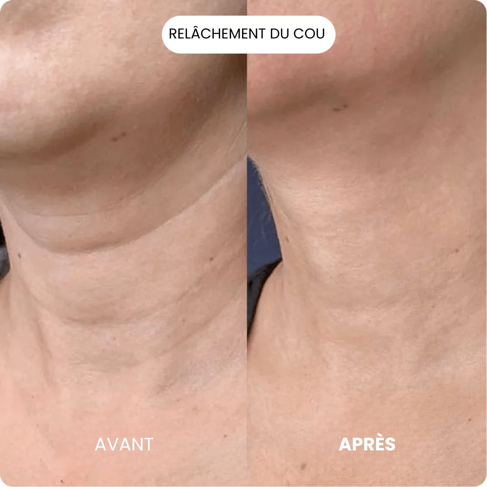 Kit de Micro Infusion