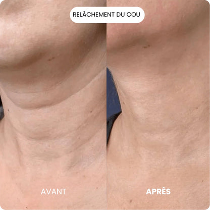 Kit de Micro Infusion